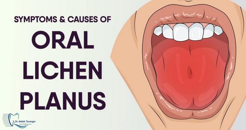 بهترین راه درمان بیماری لیکن پلان دهانی