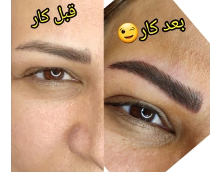 فیبروز ولیفت ابرومژه
