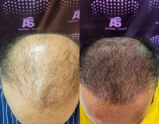 اسکالپسر در کرج میکرواسکالپ علیرضا بهشتی پور