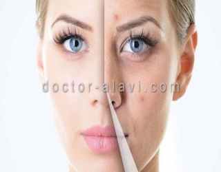 پاکسازی و رفع جوش زیرپوستی