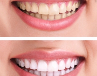 ايمپلنت /كامپوزيت /لمينيت