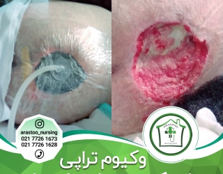 درمان زخم بستر در منزل