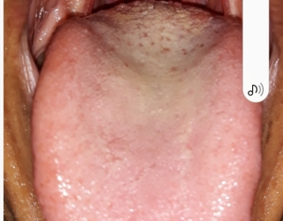 درمان بیماری از روی عکس زبان