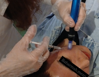 مزونیدلینگ صورت و اسکالپ سر