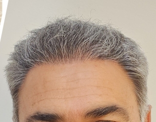 کاشت مو و ابروی طبیعی